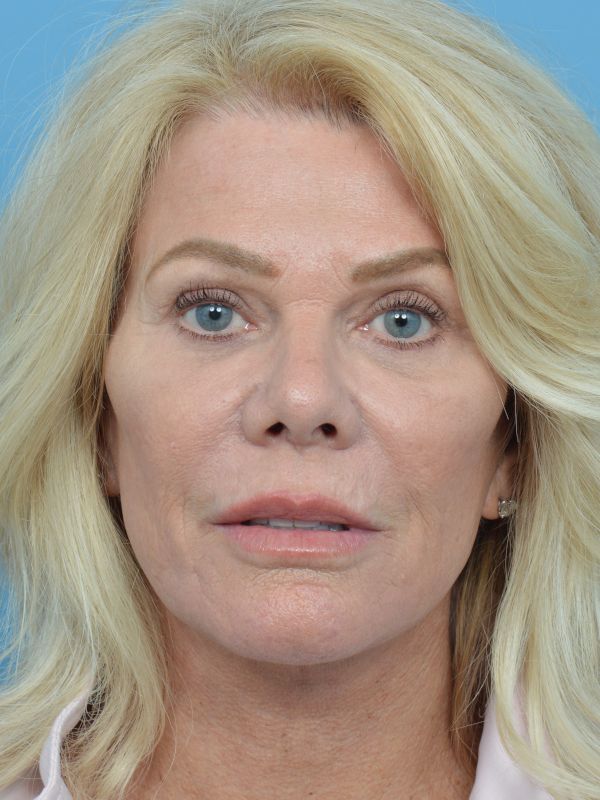 Facelift Before & After