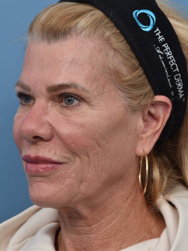 Facelift Before & After