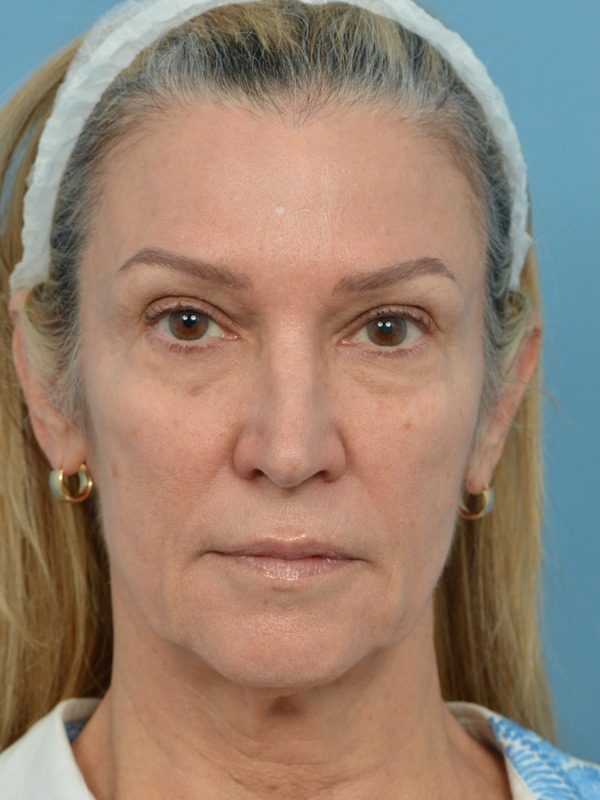Facelift Before & After