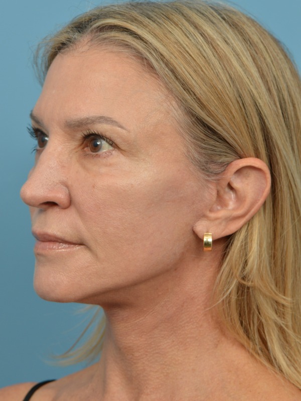 Facelift Before & After
