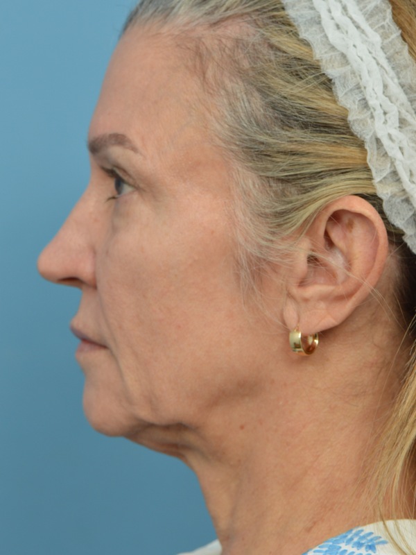 Facelift Before & After