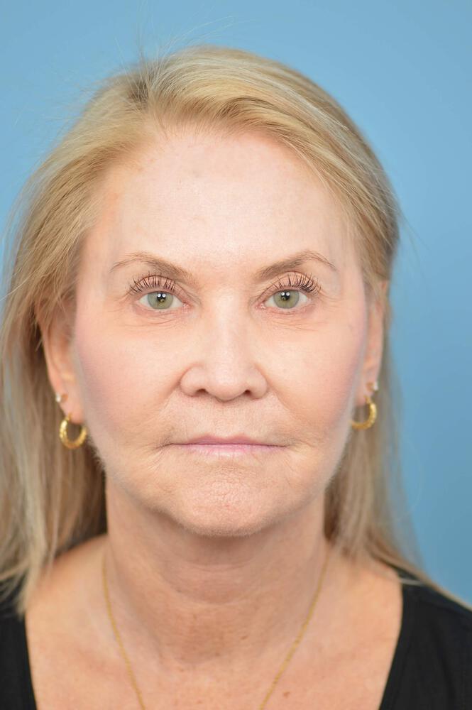 Facelift Before & After