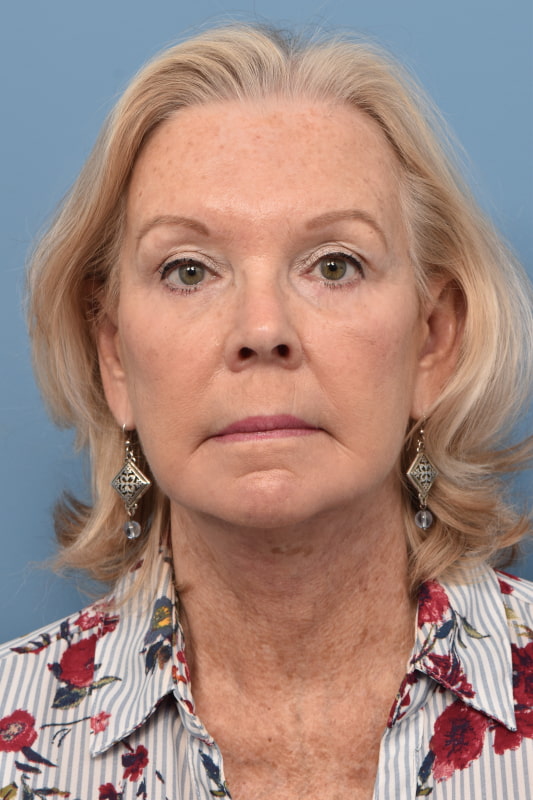 Mini Facelift Before & After