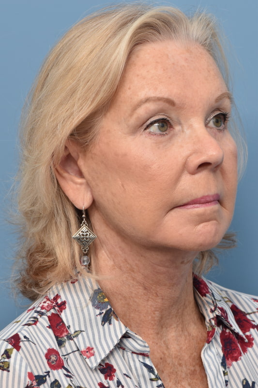 Mini Facelift Before & After