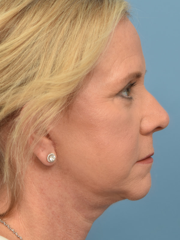 Mini Facelift Before & After