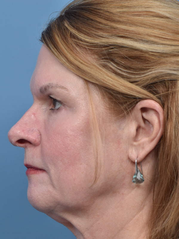 Mini Facelift Before & After