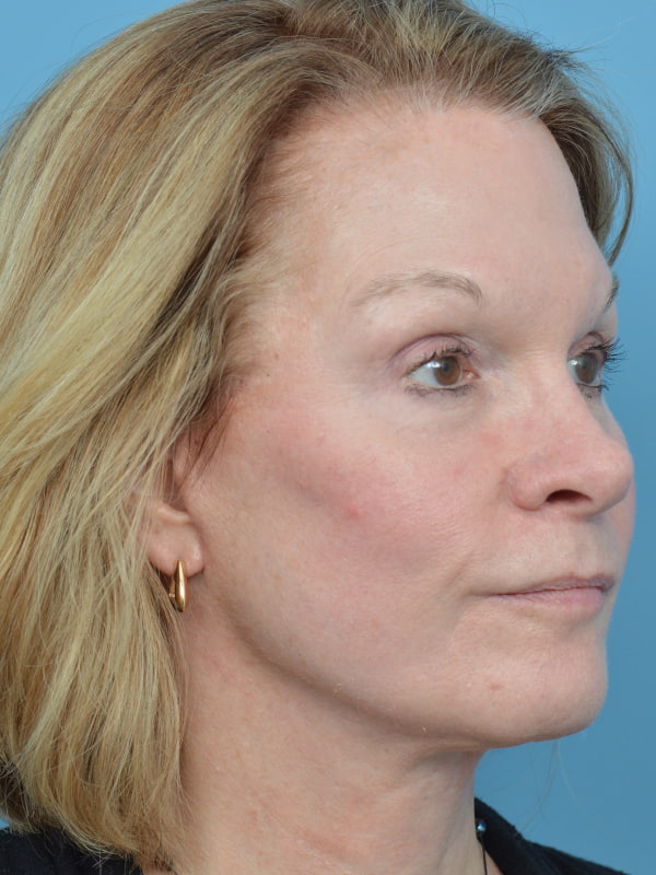 Mini Facelift Before & After