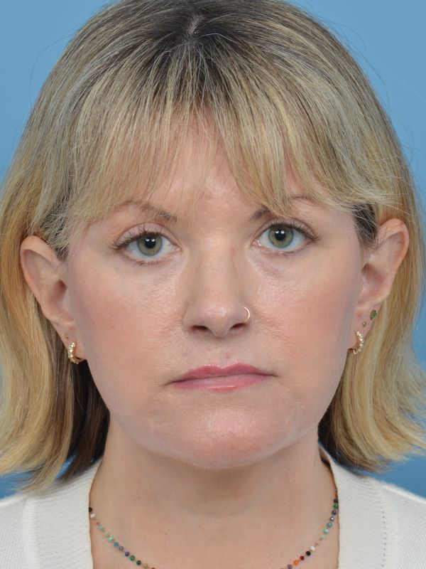 Mini Facelift Before & After