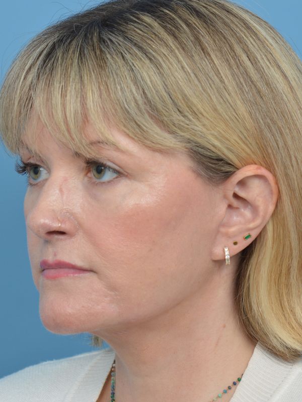 Mini Facelift Before & After