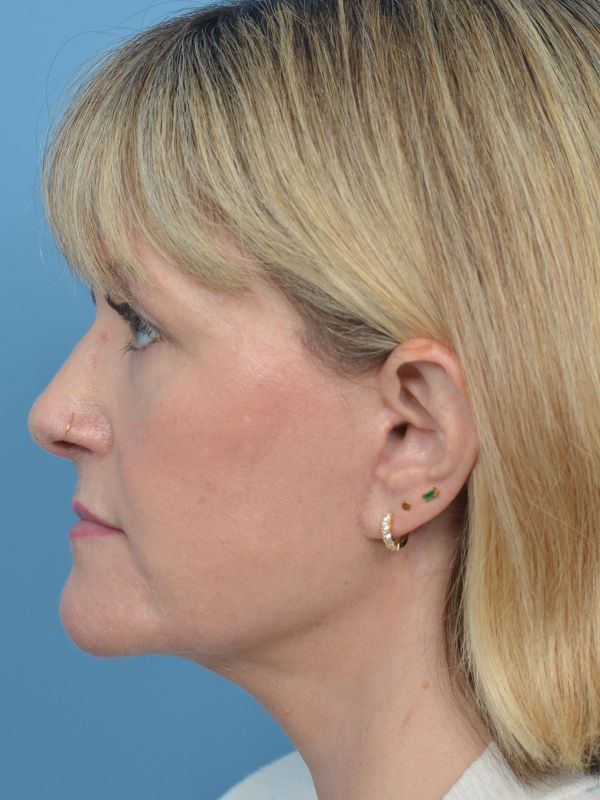 Mini Facelift Before & After