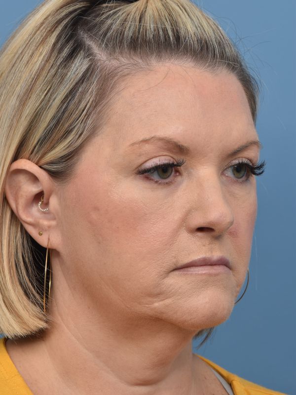 Mini Facelift Before & After