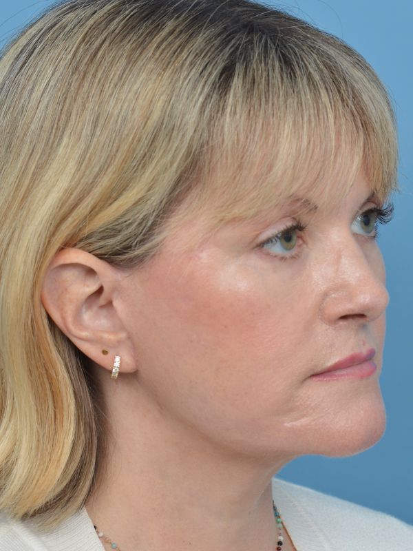 Mini Facelift Before & After