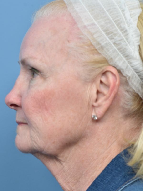 Mini Facelift Before & After