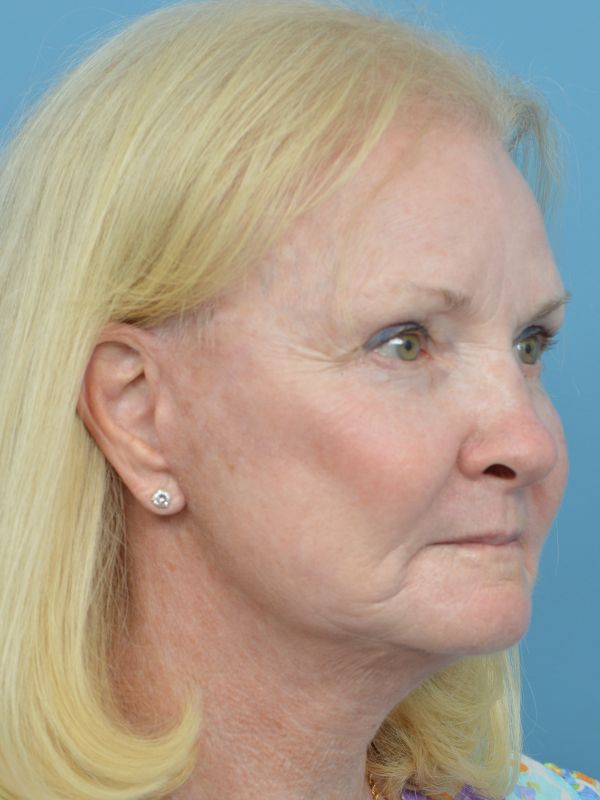 Mini Facelift Before & After