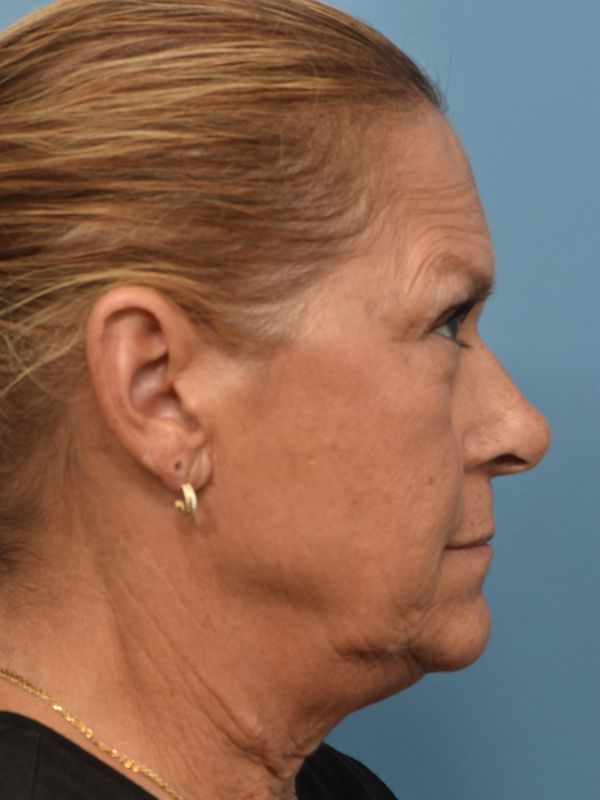 Mini Facelift Before & After