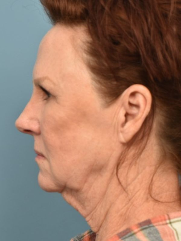 Mini Facelift Before & After