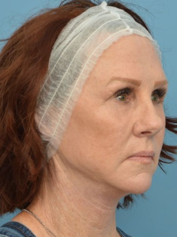 Mini Facelift Before & After