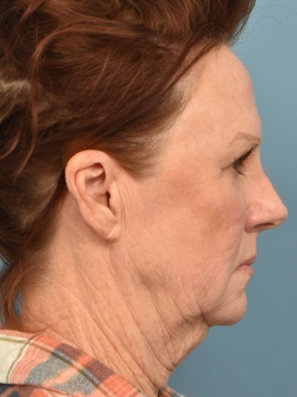 Mini Facelift Before & After