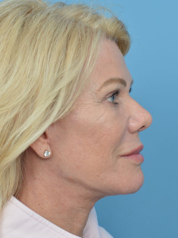 Mini Facelift Before & After