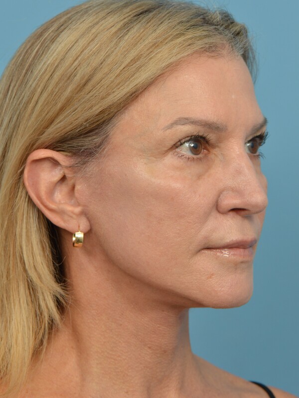 Mini Facelift Before & After