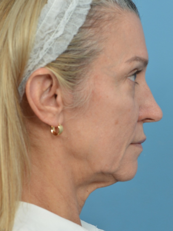 Mini Facelift Before & After