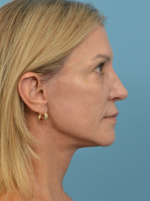 Mini Facelift Before & After