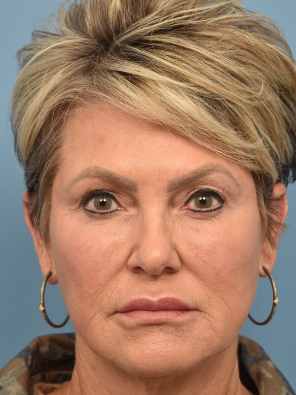 Mini Facelift Before & After