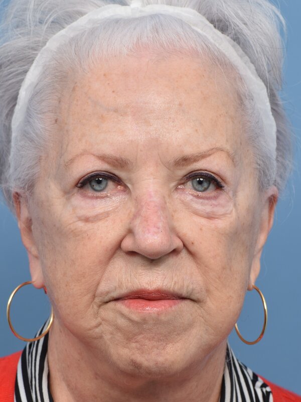 Mini Facelift Before & After