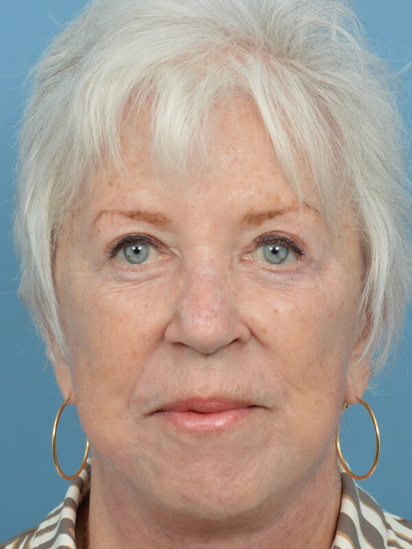 Mini Facelift Before & After