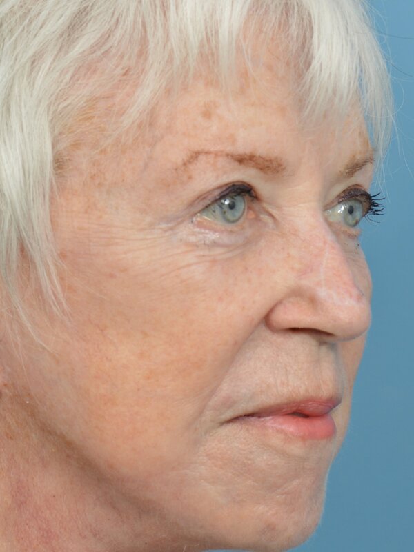 Mini Facelift Before & After