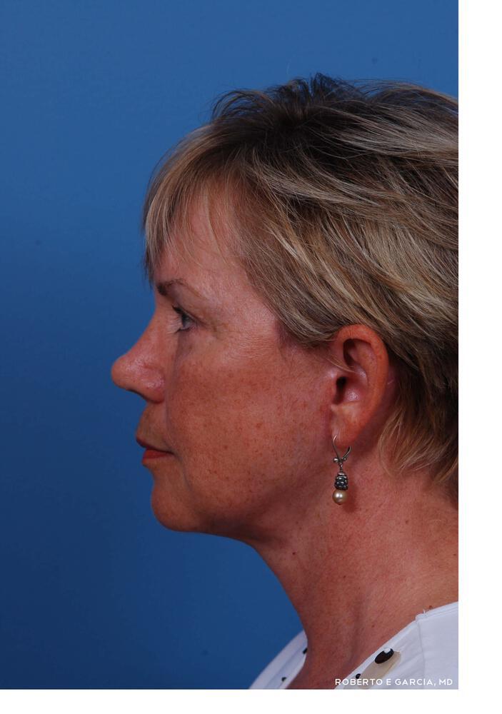 Neck Lift Before & After
