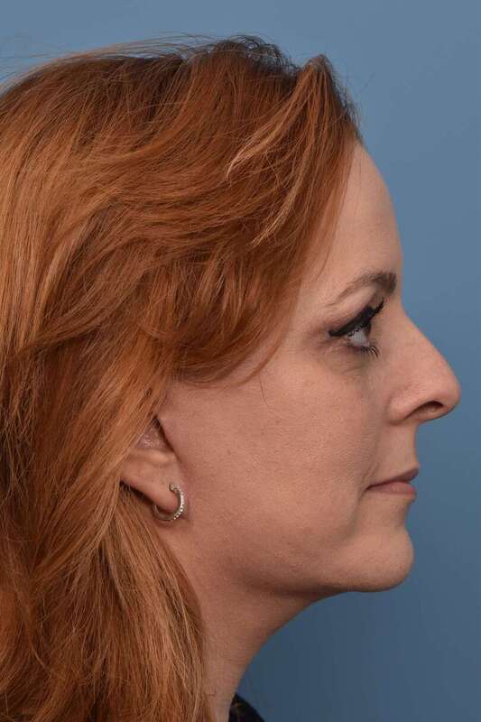 Neck Lift Before & After