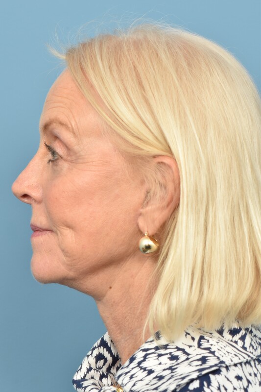 Neck Lift Before & After