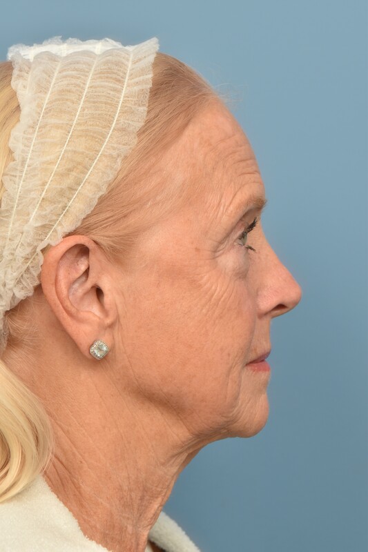 Neck Lift Before & After