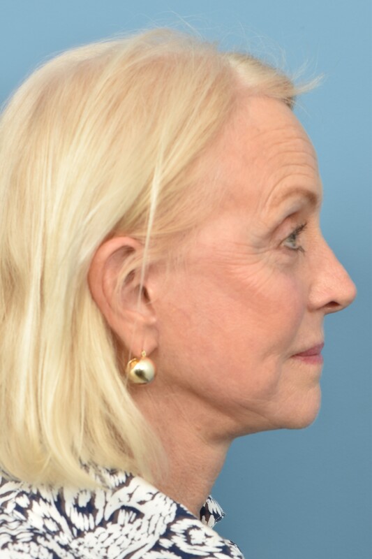 Neck Lift Before & After