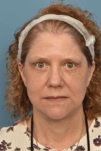 Neck Lift Before & After