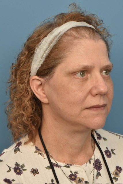 Neck Lift Before & After