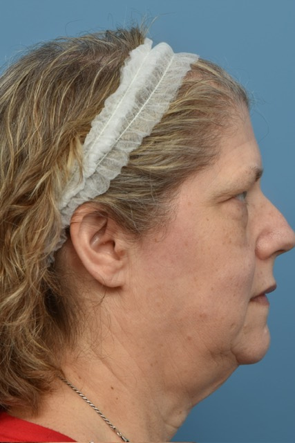 Neck Lift Before & After