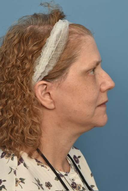 Neck Lift Before & After