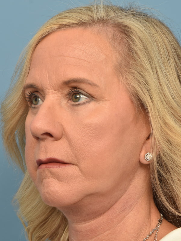 Neck Lift Before & After