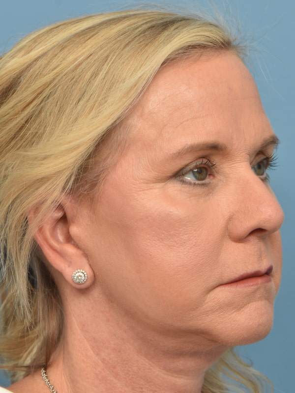 Neck Lift Before & After