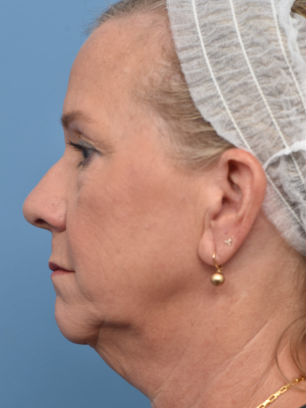 Neck Lift Before & After