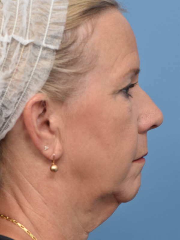 Neck Lift Before & After