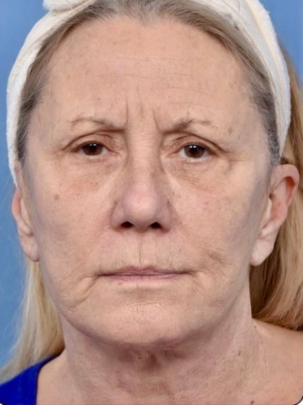 Neck Lift Before & After