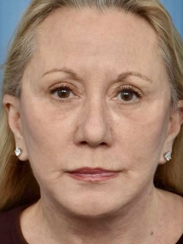 Neck Lift Before & After