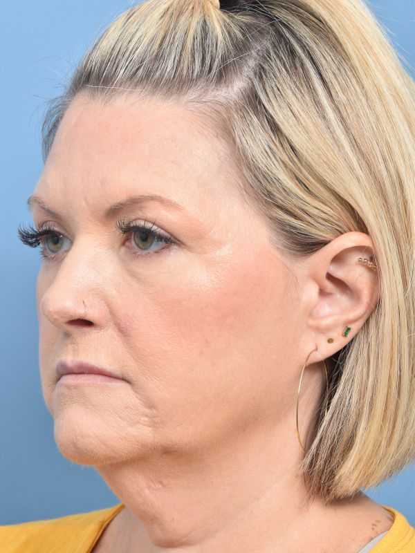 Neck Lift Before & After