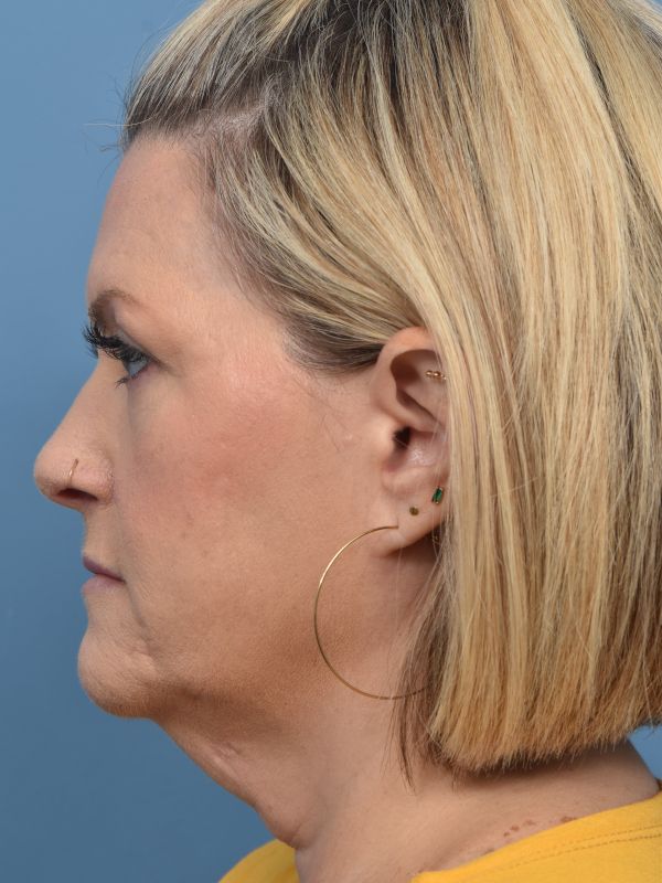 Neck Lift Before & After