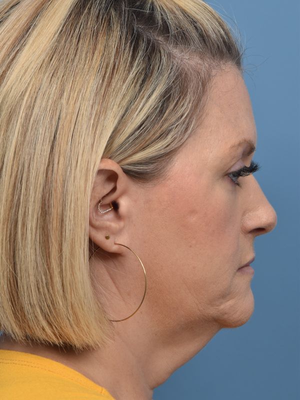 Neck Lift Before & After