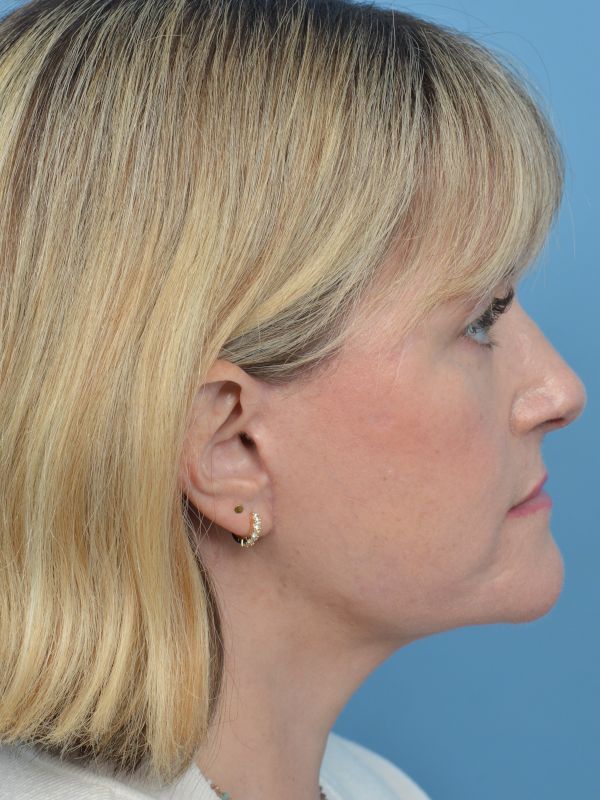 Neck Lift Before & After