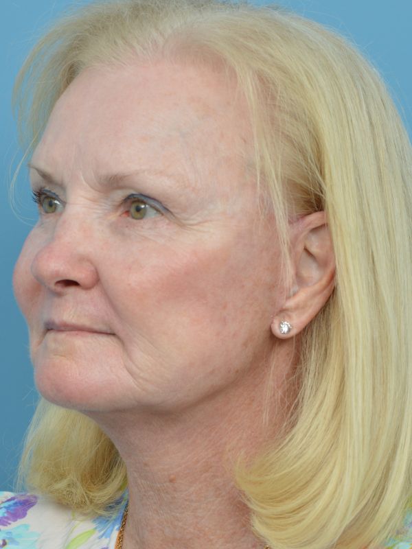 Neck Lift Before & After